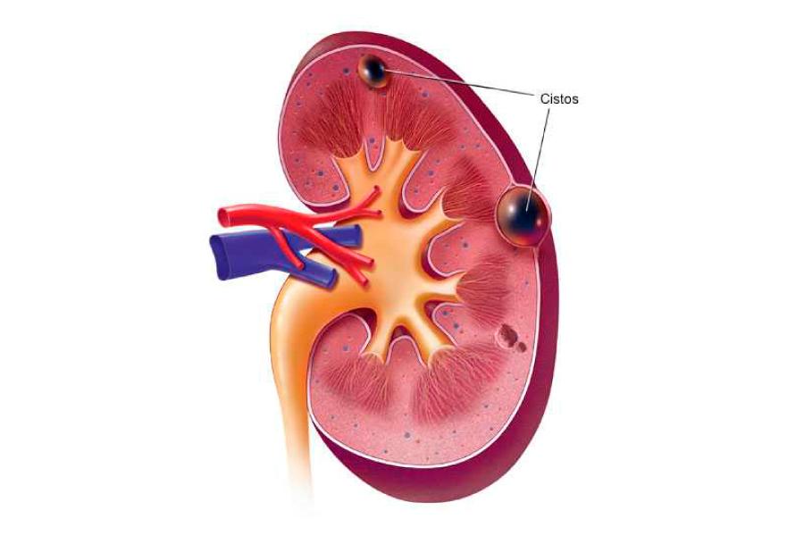 Cisto renal